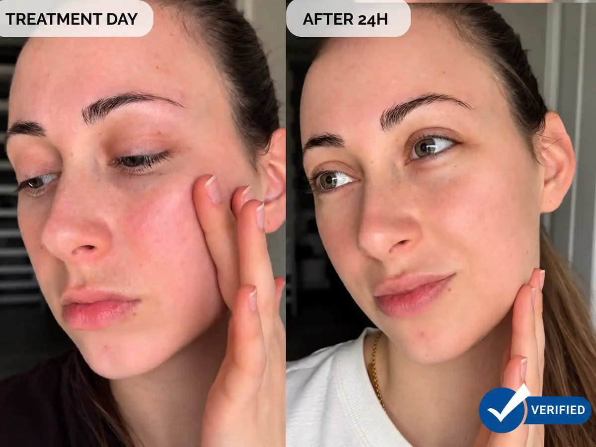 Vorher-Nachher-Split-Screen mit dem Gesicht einer Frau nach 24 Stunden YUTH-Mikroinfusionsbehandlung, links mit „TREATMENT DAY“ und rechts mit „AFTER 24H“ sowie einem blauen „VERIFIED“-Badge.