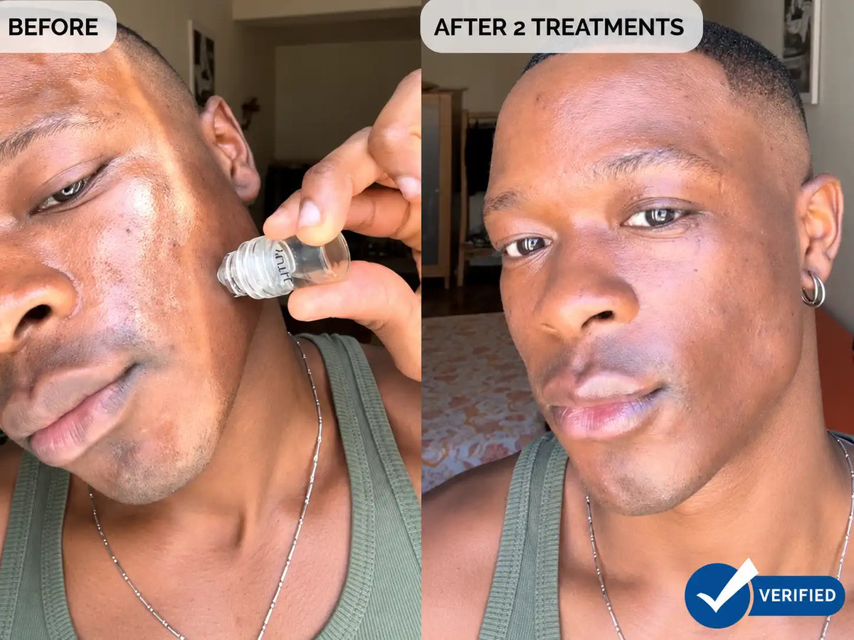 Ein Split-Screen-Vorher-Nachher-Vergleich mit dem Gesicht eines Mannes; die linke Seite ist mit „BEFORE“ und die rechte Seite mit „AFTER 2 TREATMENTS“ beschriftet. Auf der linken Seite hält eine Hand ein Kupferpeptid-Mikroinfusionssystem an seine Wange.