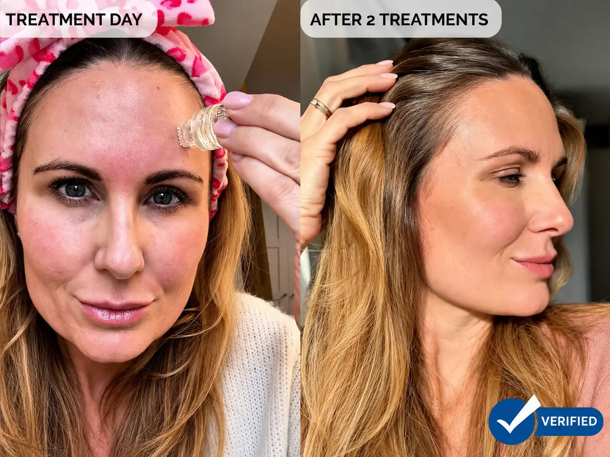 Geteilte Vorher-nachher-Ansicht mit den Ergebnissen einer Hautbehandlung bei einer Frau. Die linke Seite mit der Beschriftung „TREATMENT DAY“ zeigt sie mit einem rosa gemusterten Haarband, während sie eine YUTH-Kupferpeptid-Mikroinfusion auf ihre Stirn aufträgt.