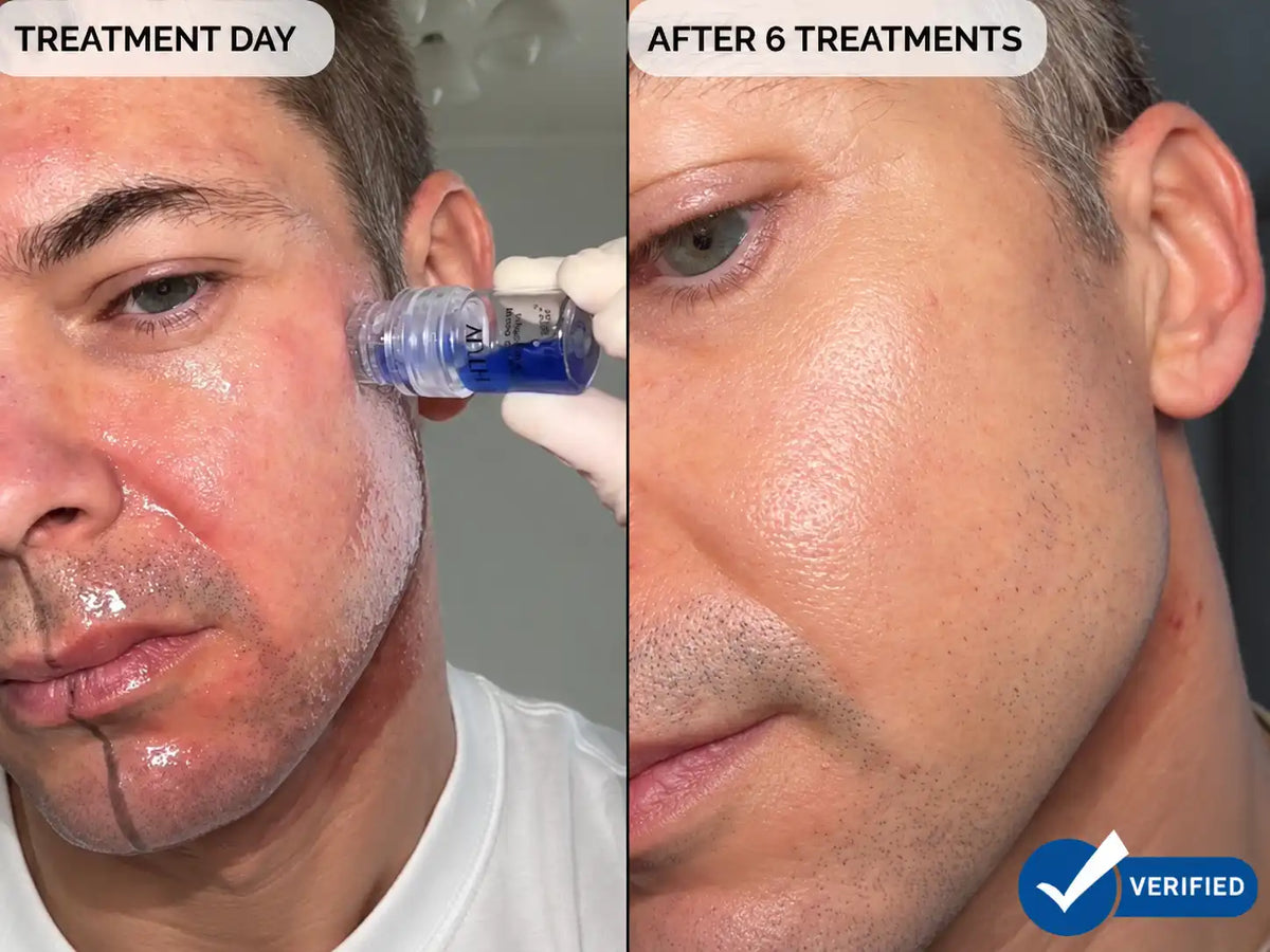 Vorher-Nachher-Split-Screen mit dem Gesicht eines Mannes nach einer YUTH-Mikroinfusionsbehandlung mit Kupferpeptiden, links mit „BEHANDLUNGSTAG“ und rechts mit „NACH 6 BEHANDLUNGEN“. Eine behandschuhte Hand setzt ein blau-transparentes Kosmetikgerät an seiner Schläfe an.