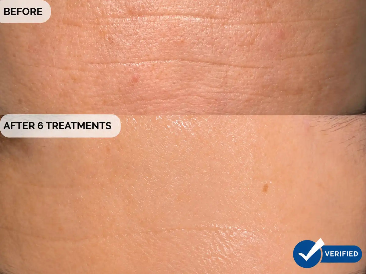 Nahaufnahme eines Vorher-Nachher-Vergleichs der Hautstruktur auf der Stirn, wobei das obere Bild mit BEFORE und das untere Bild mit AFTER 6 TREATMENTS beschriftet ist. In der unteren rechten Ecke ist ein blaues Verifizierungsabzeichen zu sehen.