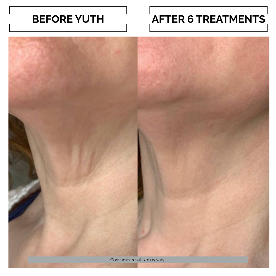 Before and after comparison of skin micro.infusion treatment on a neck area with text indicating 'Before Yuth' and 'After 6 Treatments'.