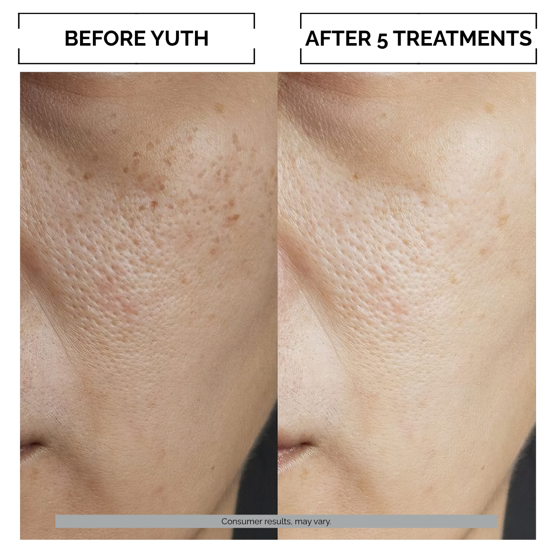 Before and after comparison of micro infusion skin treatment with 'Before Yuth' and 'After 5 Treatments' labels.