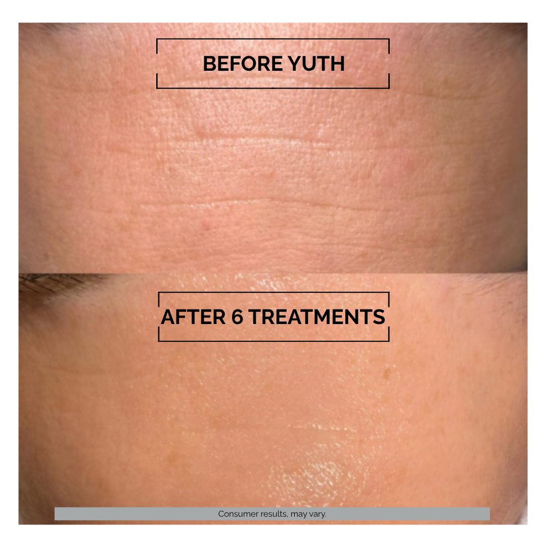 Before and after comparison of skin treatment with 'Before Yuth' and 'After 6 Treatments' labels.
