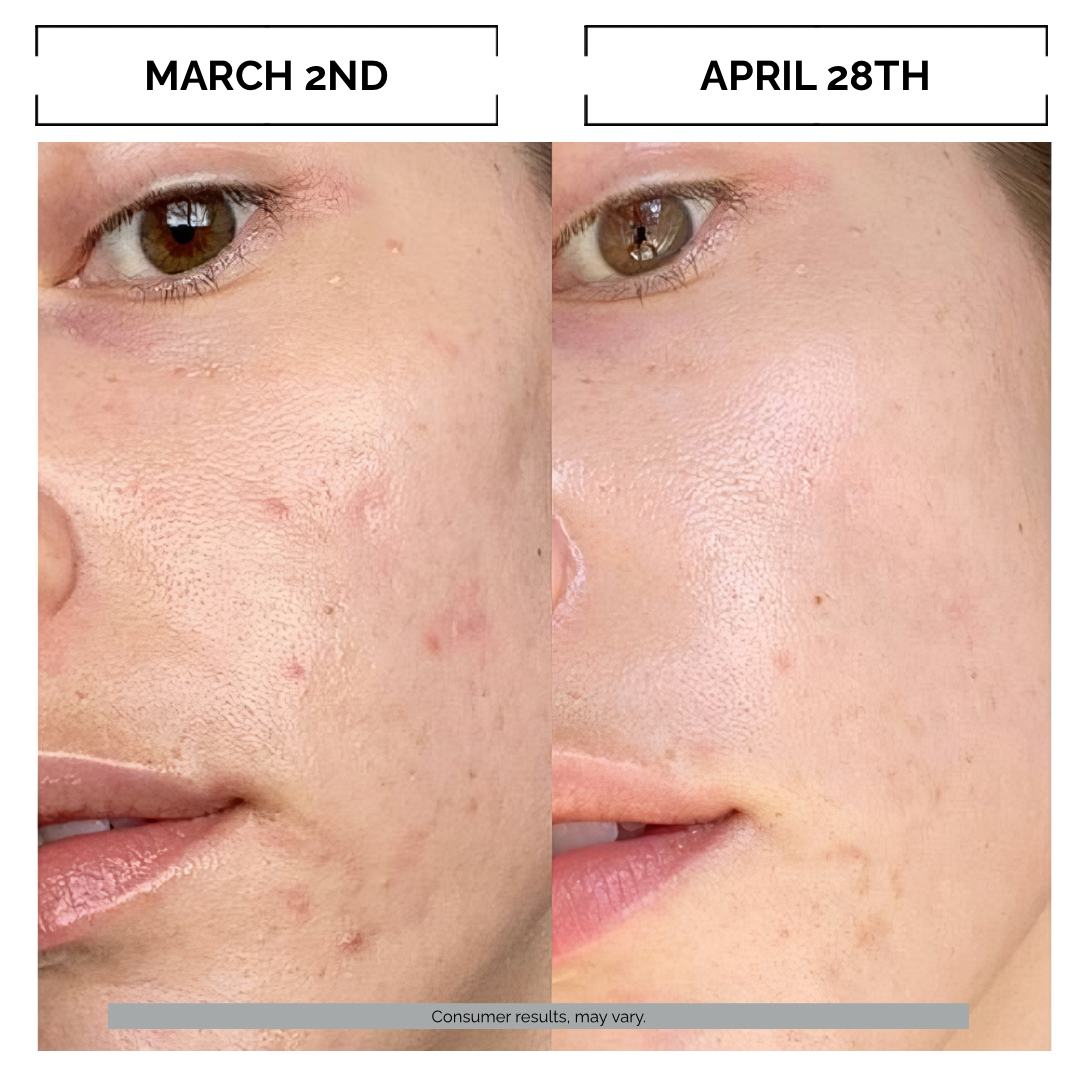 Before and after micro infusion comparison of skin condition skin elasticity collagen production fine lines